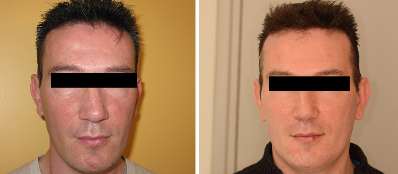 Photo avant / après de rajeunissement du visage par injections chez un homme Photo avant / après de rajeunissement du visage par injections chez un homme