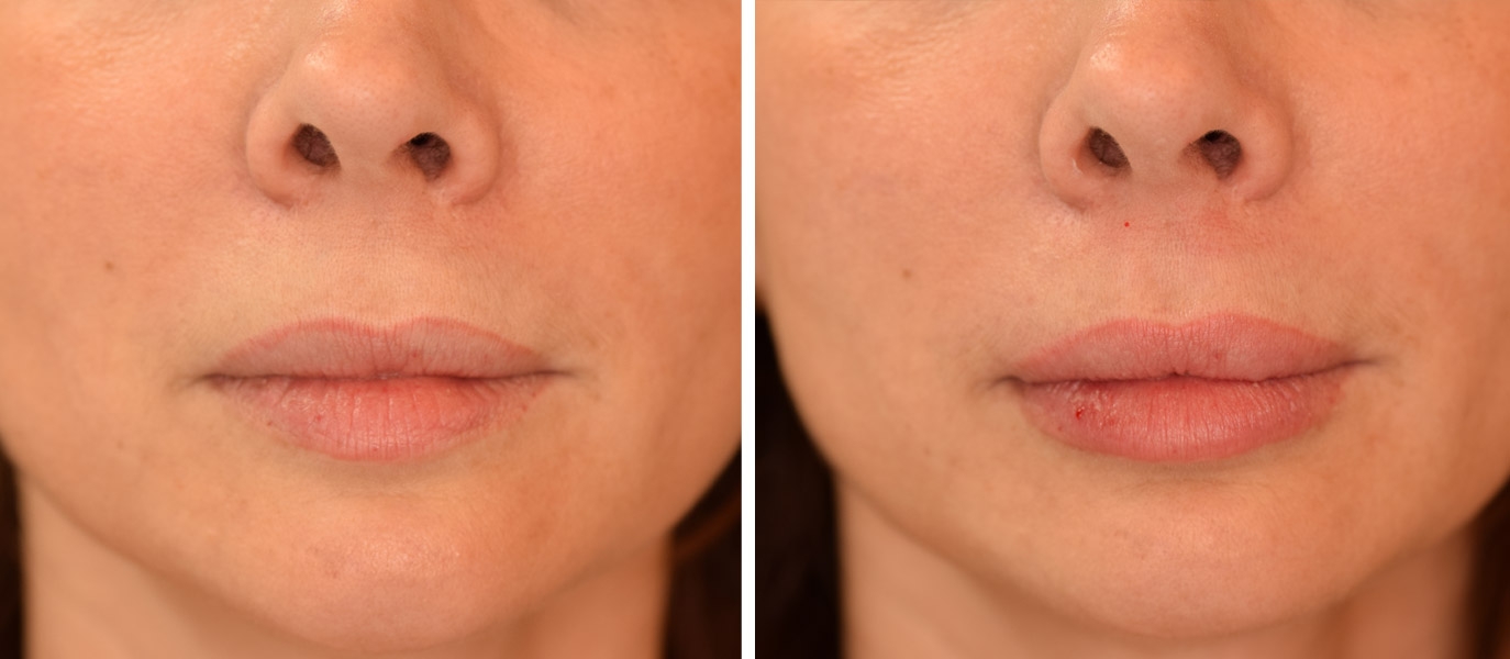 Photo avant / après embellissement de la bouche par injections d'acide hyaluronique Photo avant / après embellissement de la bouche par injections d'acide hyaluronique