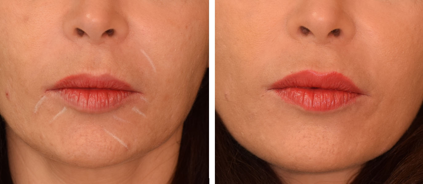 Photo avant / après embellissement de la bouche par injections d'acide hyaluronique Photo avant / après embellissement de la bouche par injections d'acide hyaluronique
