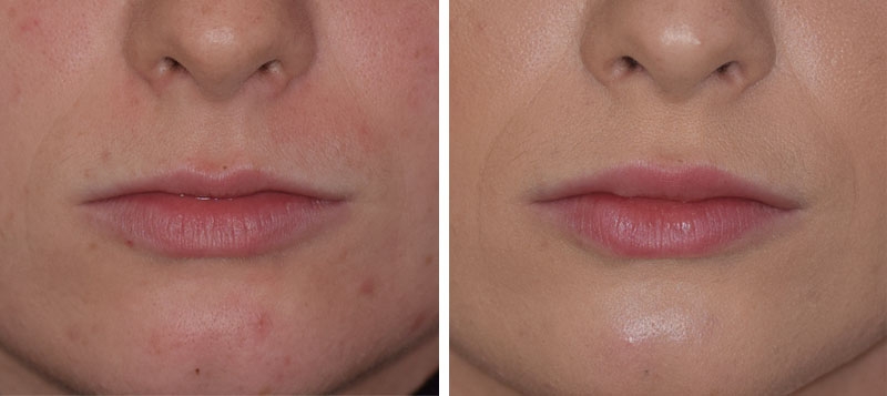 Photo avant après embellissement de la bouche par injections d'acide hyaluronique par le Dr Body à Tours Photo avant après embellissement de la bouche par injections d'acide hyaluronique par le Dr Body à Tours