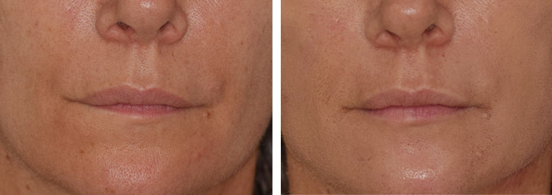 Photo avant après embellissement de la bouche par injections d'acide hyaluronique par le Dr Body à Tours Photo avant après embellissement de la bouche par injections d'acide hyaluronique par le Dr Body à Tours