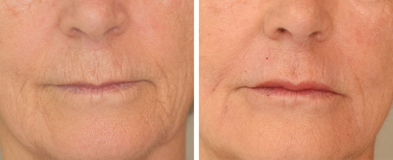 Photo avant après embellissement de la bouche par injections d'acide hyaluronique par le Dr Body à Tours Photo avant après embellissement de la bouche par injections d'acide hyaluronique par le Dr Body à Tours