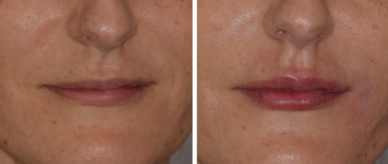 Photo avant après embellissement de la bouche par injections d'acide hyaluronique par le Dr Body à Tours Photo avant après embellissement de la bouche par injections d'acide hyaluronique par le Dr Body à Tours