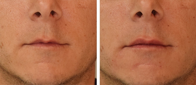 Photo avant après embellissement de la bouche par injections d'acide hyaluronique par le Dr Body à Tours Photo avant après embellissement de la bouche par injections d'acide hyaluronique par le Dr Body à Tours