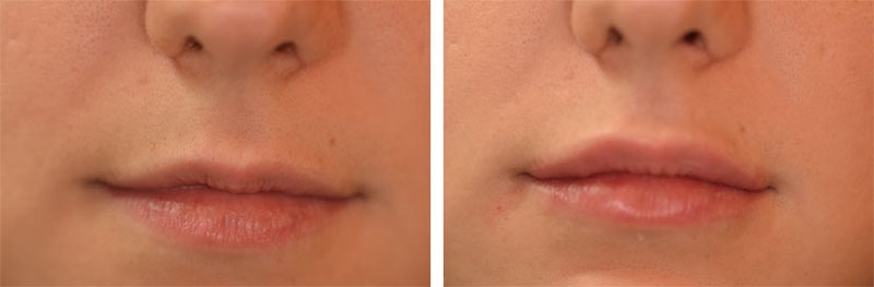 Photo avant après embellissement de la bouche par injections d'acide hyaluronique par le Dr Body à Tours Photo avant après embellissement de la bouche par injections d'acide hyaluronique par le Dr Body à Tours
