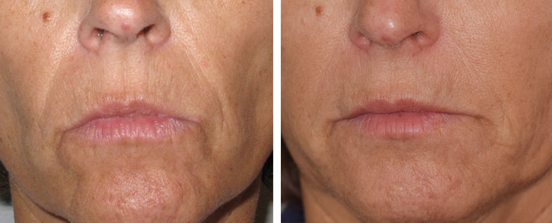 Photo avant après embellissement de la bouche par injections d'acide hyaluronique par le Dr Body à Tours Photo avant après embellissement de la bouche par injections d'acide hyaluronique par le Dr Body à Tours