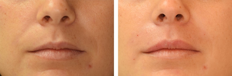 Photo avant après embellissement de la bouche par injections d'acide hyaluronique par le Dr Body à Tours Photo avant après embellissement de la bouche par injections d'acide hyaluronique par le Dr Body à Tours