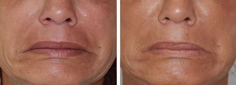 Photo avant après embellissement de la bouche par injections d'acide hyaluronique par le Dr Body à Tours Photo avant après embellissement de la bouche par injections d'acide hyaluronique par le Dr Body à Tours