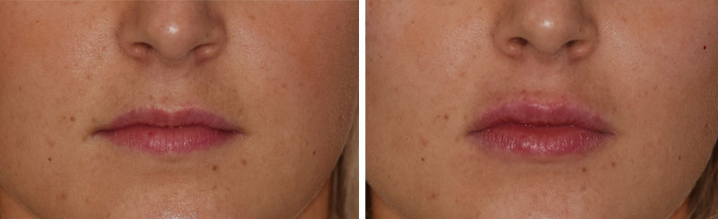 Photo avant après embellissement de la bouche par injections d'acide hyaluronique par le Dr Body à Tours Photo avant après embellissement de la bouche par injections d'acide hyaluronique par le Dr Body à Tours