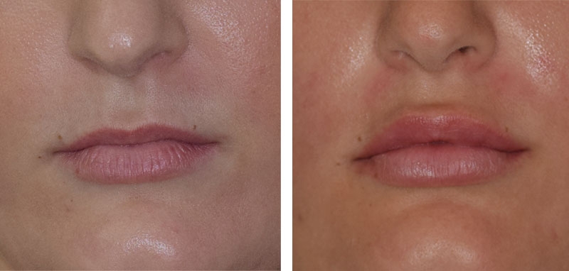 Photo avant après embellissement de la bouche par injections d'acide hyaluronique par le Dr Body à Tours Photo avant après embellissement de la bouche par injections d'acide hyaluronique par le Dr Body à Tours