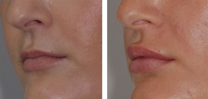 Photo avant après embellissement de la bouche par injections d'acide hyaluronique par le Dr Body à Tours Photo avant après embellissement de la bouche par injections d'acide hyaluronique par le Dr Body à Tours