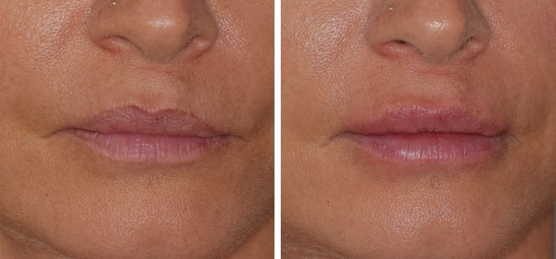 Photo avant après embellissement de la bouche par injections d'acide hyaluronique par le Dr Body à Tours Photo avant après embellissement de la bouche par injections d'acide hyaluronique par le Dr Body à Tours