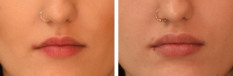 Photo avant après embellissement de la bouche par injections d'acide hyaluronique par le Dr Body à Tours Photo avant après embellissement de la bouche par injections d'acide hyaluronique par le Dr Body à Tours