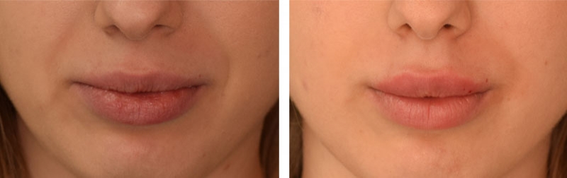 Photo avant après embellissement de la bouche par injections d'acide hyaluronique par le Dr Body à Tours Photo avant après embellissement de la bouche par injections d'acide hyaluronique par le Dr Body à Tours