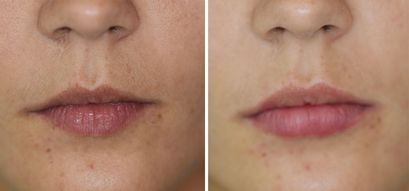 Photo avant après embellissement de la bouche par injections d'acide hyaluronique par le Dr Body à Tours Photo avant après embellissement de la bouche par injections d'acide hyaluronique par le Dr Body à Tours