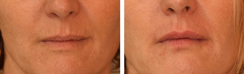 Photo avant après rajeunissement de la bouche par injections d'acide hyaluronique par le Dr Body à Tours Photo avant après rajeunissement de la bouche par injections d'acide hyaluronique par le Dr Body à Tours