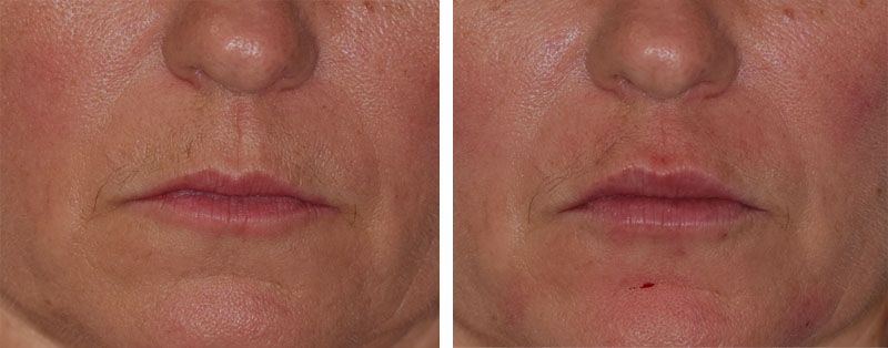 Photo avant après rajeunissement de la bouche par injections d'acide hyaluronique par le Dr Body à Tours Photo avant après rajeunissement de la bouche par injections d'acide hyaluronique par le Dr Body à Tours