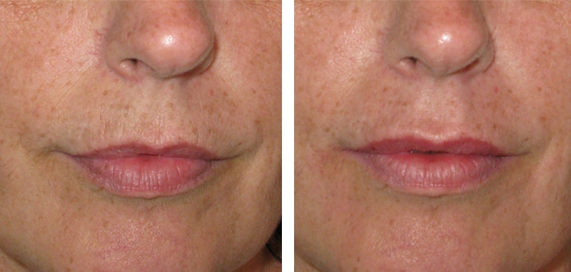Photo avant après rajeunissement de la bouche par injections d'acide hyaluronique par le Dr Body à Tours Photo avant après rajeunissement de la bouche par injections d'acide hyaluronique par le Dr Body à Tours