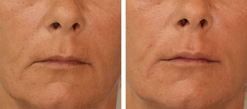 Photo avant après rajeunissement de la bouche par injections d'acide hyaluronique par le Dr Body à Tours Photo avant après rajeunissement de la bouche par injections d'acide hyaluronique par le Dr Body à Tours