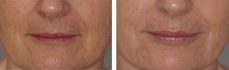 Photo avant après rajeunissement de la bouche par injections d'acide hyaluronique par le Dr Body à Tours Photo avant après rajeunissement de la bouche par injections d'acide hyaluronique par le Dr Body à Tours