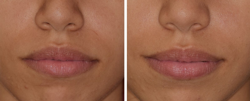 Photo avant après traitement du sourire gingival par injections de toxine botulique par le Dr Body à Tours Photo avant après traitement du sourire gingival par injections de toxine botulique par le Dr Body à Tours
