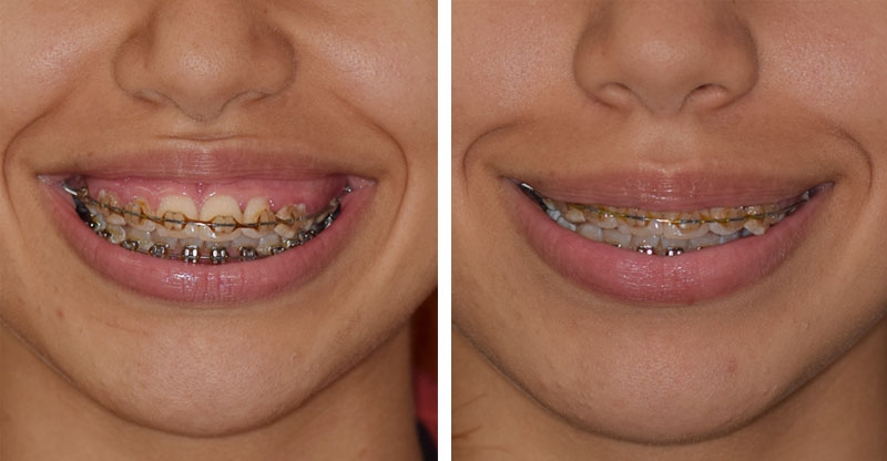 Photo avant après traitement du sourire gingival par injections de toxine botulique par le Dr Body à Tours Photo avant après traitement du sourire gingival par injections de toxine botulique par le Dr Body à Tours
