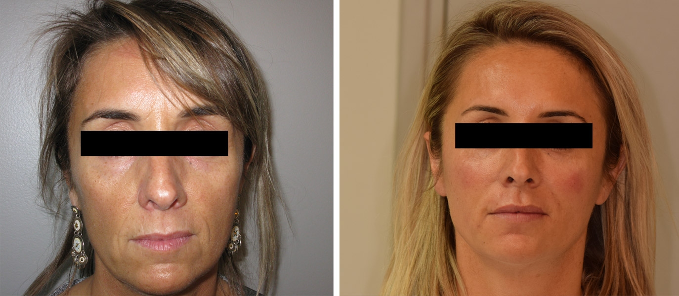 Photos avant / après de rajeunissement complet du visage par injections Photos avant / après de rajeunissement complet du visage par injections