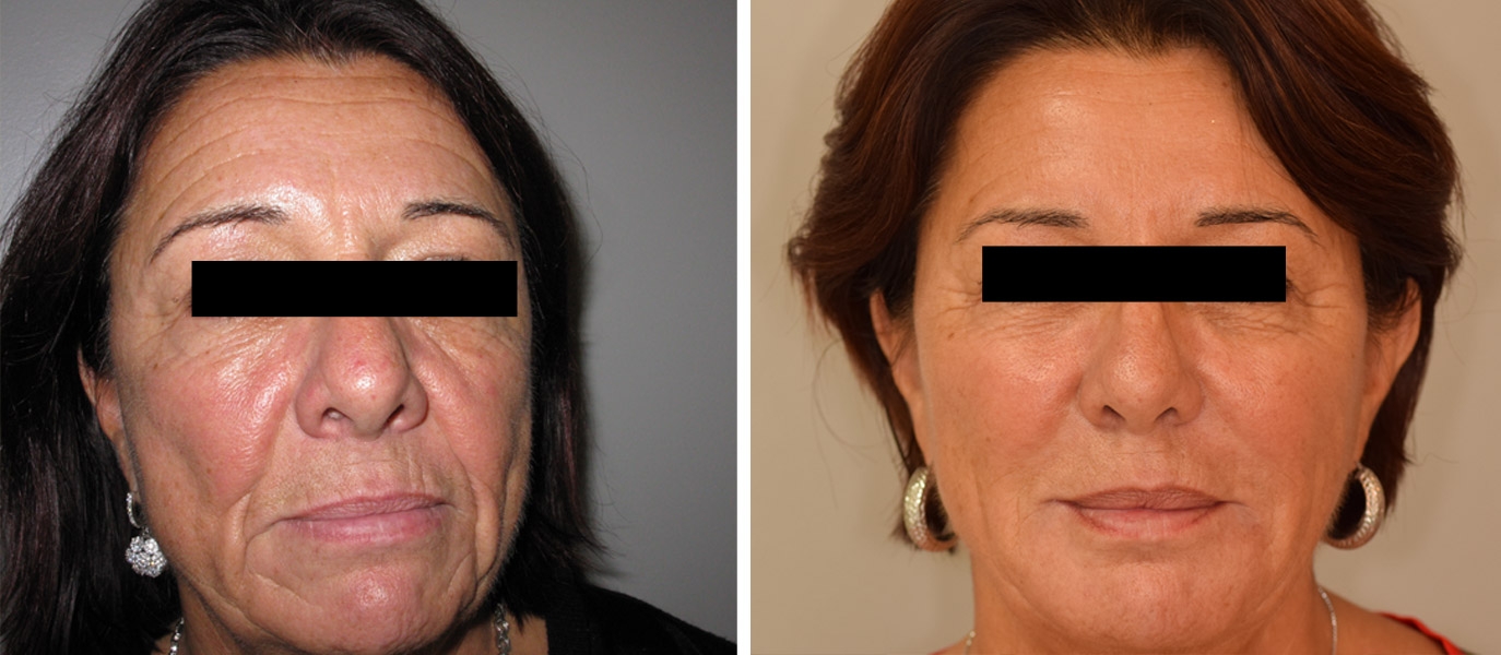 Photos avant / après de rajeunissement complet du visage par injections Photos avant / après de rajeunissement complet du visage par injections