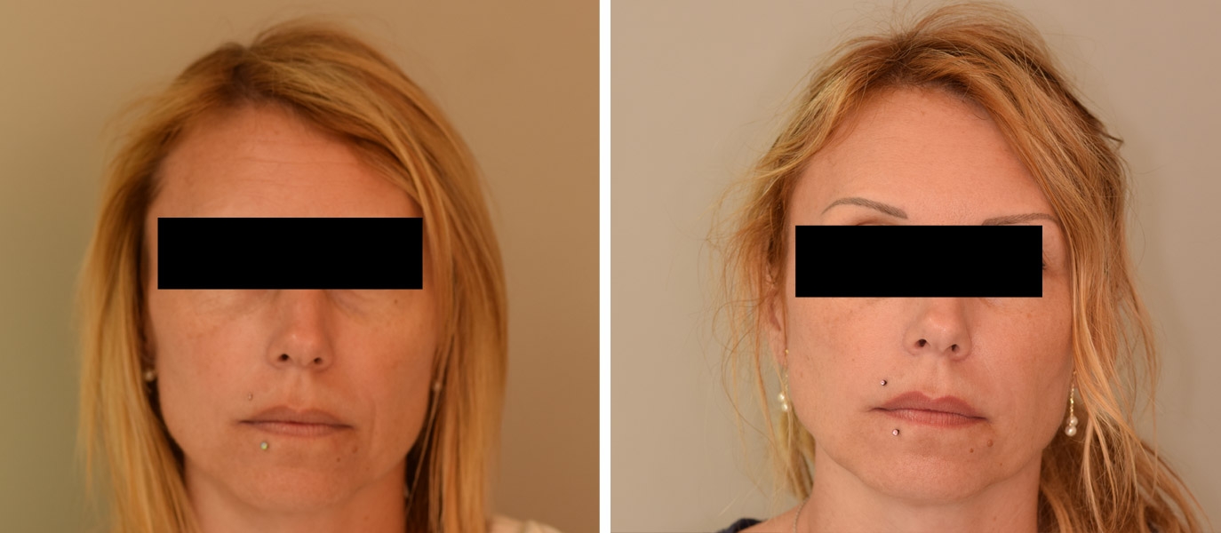 Photos avant / après de rajeunissement complet du visage par injections Photos avant / après de rajeunissement complet du visage par injections