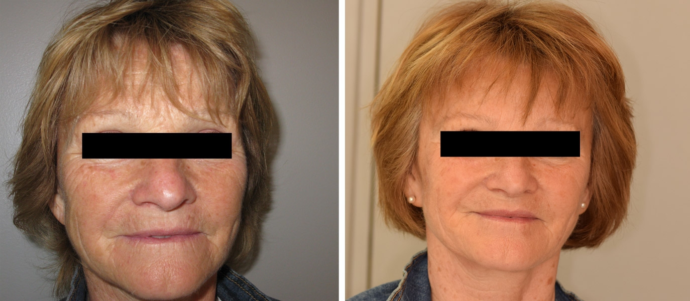 Photos avant / après de rajeunissement complet du visage par injections Photos avant / après de rajeunissement complet du visage par injections