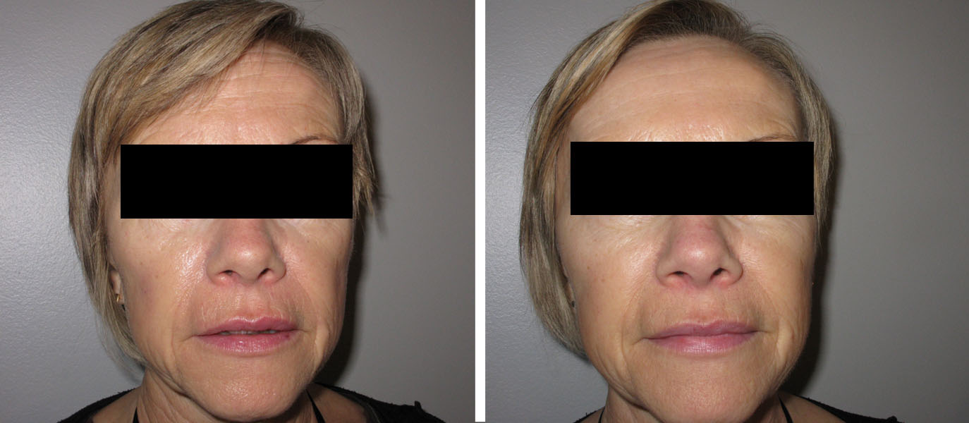 Lifting sans chirrugie : injections de Botox et d'acide hyaluronique