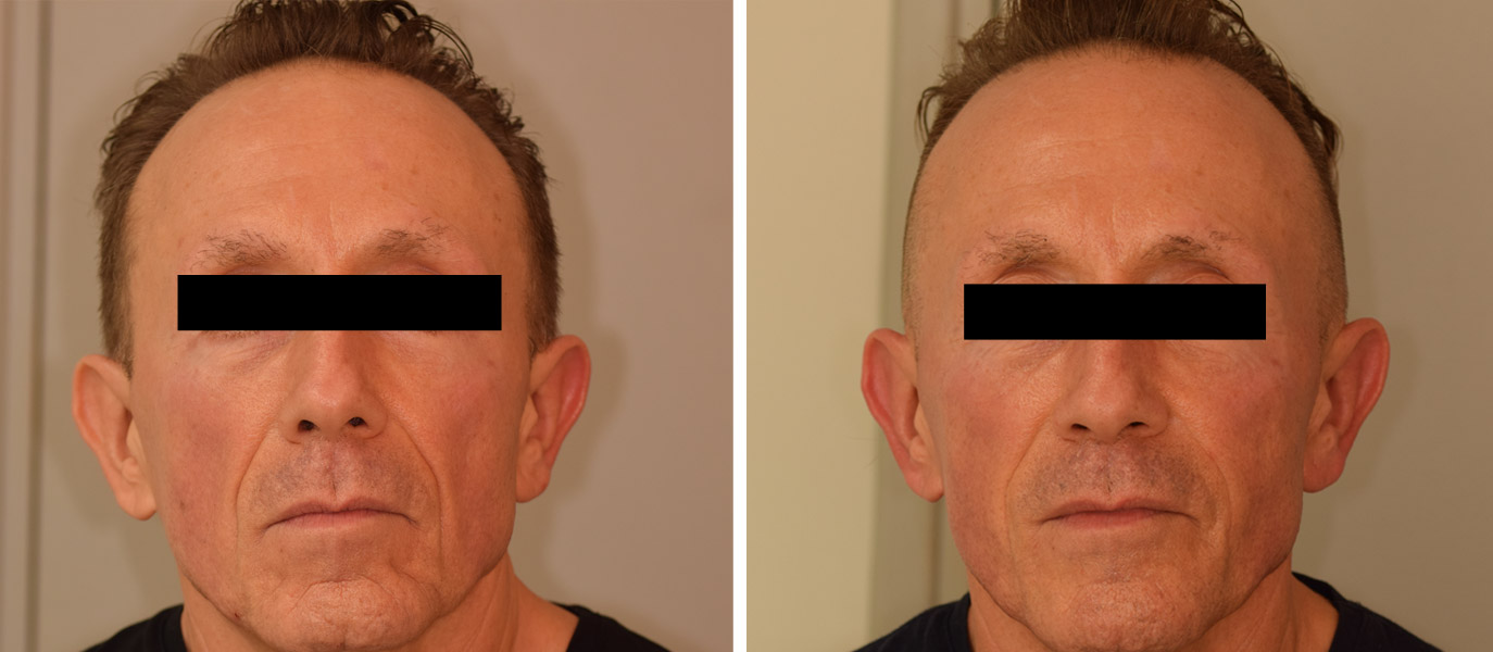 Photo avant / après de rajeunissement du visage par injections chez un homme