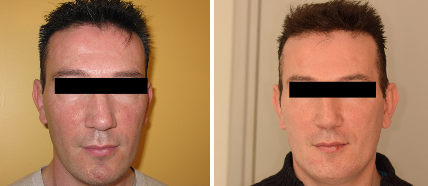 Photo avant / après de rajeunissement du visage par injections chez un homme