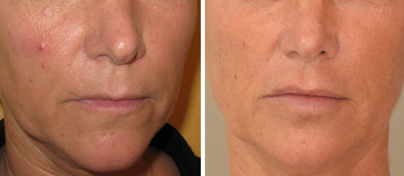 Photo avant / après embellissement de la bouche par injections d'acide hyaluronique