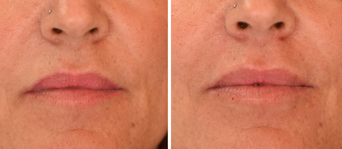 Photo avant / après embellissement de la bouche par injections d'acide hyaluronique