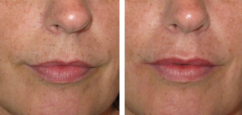 Photo avant après rajeunissement de la bouche par injections d'acide hyaluronique par le Dr Body à Tours