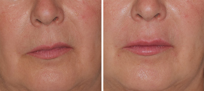 Photo avant après rajeunissement de la bouche par injections d'acide hyaluronique par le Dr Body à Tours