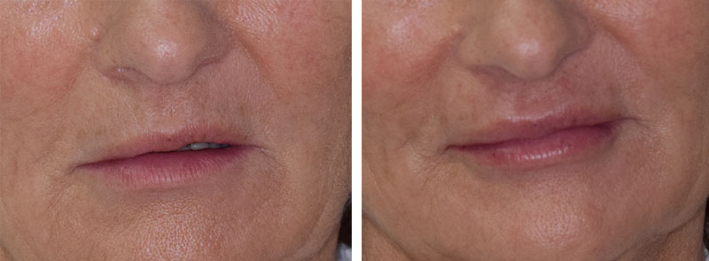 Photo avant après rajeunissement de la bouche par injections d'acide hyaluronique par le Dr Body à Tours