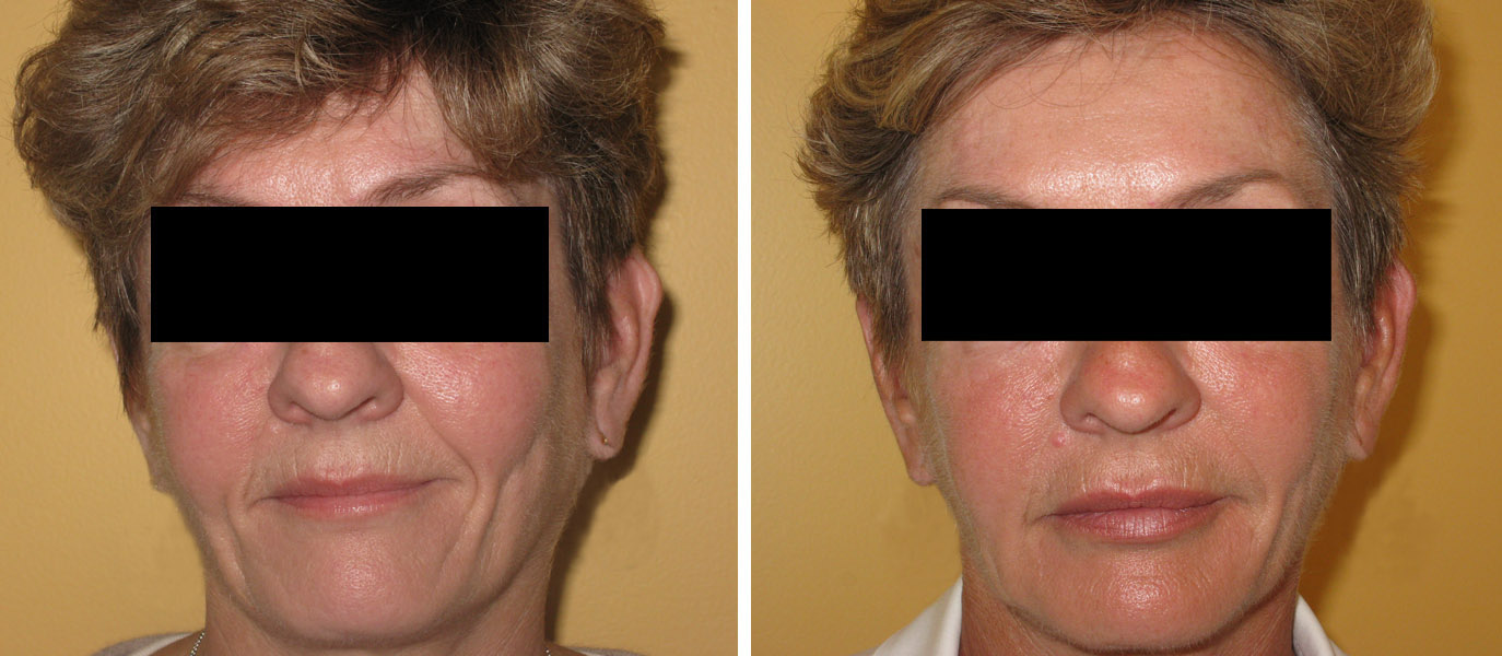 Photo avant / après traitement des rides du front par Botox