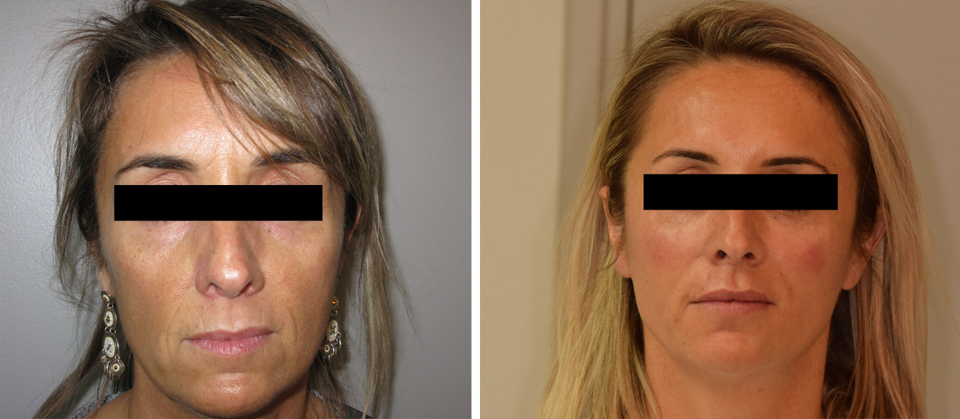 Photos avant / après de rajeunissement complet du visage par injections