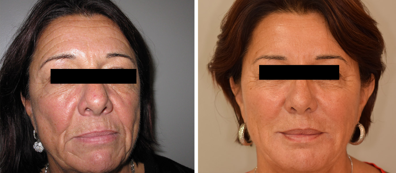 Photos avant / après de rajeunissement complet du visage par injections