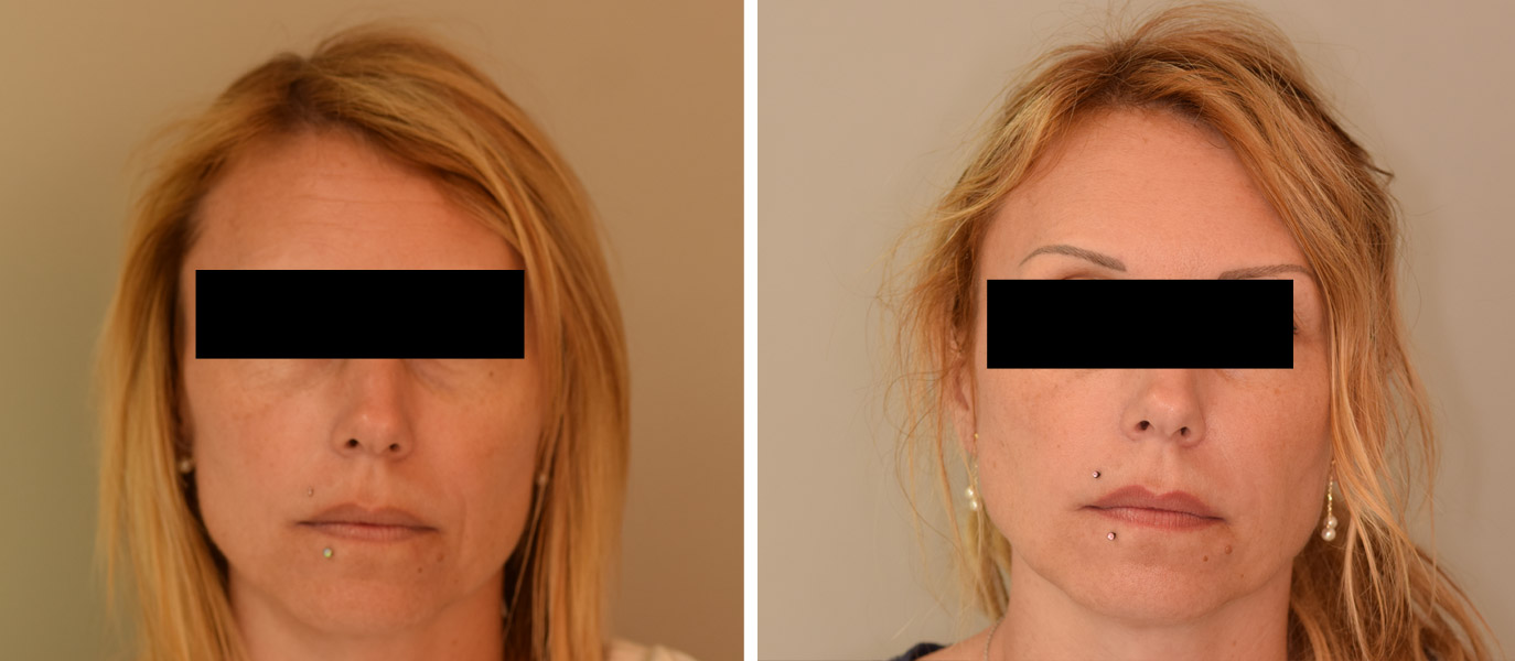 Photos avant / après de rajeunissement complet du visage par injections