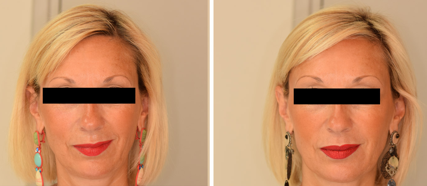 Photos avant / après de rajeunissement complet du visage par injections