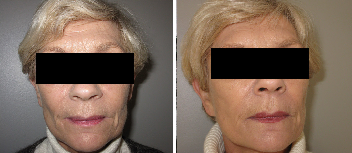 Rajeunissement par injections de Botox et d'acide hyaluronique