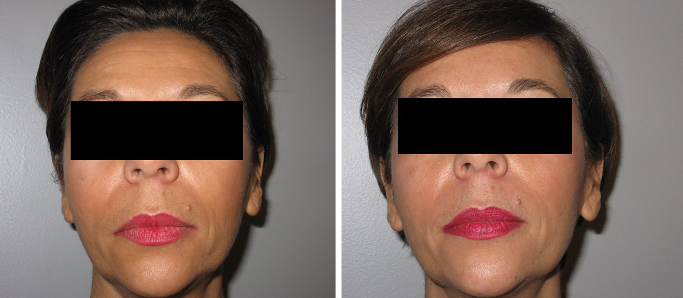 Traitement des rides du front par injections de Botox